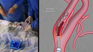 Extracranial Thrombectomy with eSAVE [upl. by Knick356]