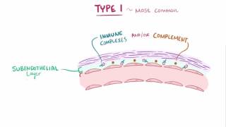 Analgesic Nephropathy AN Kidney Damage from NSAIDs [upl. by Underwood139]