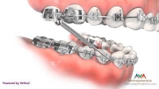 Orthodontic Treatment for Overjet Overbite  Forsus Appliance [upl. by Binah]