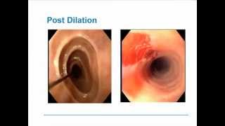 Eosinophilic Esophagitis [upl. by Aloysius]