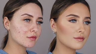 HOW TO COVER ACNE SCARS easy amp non cakey [upl. by Keil]