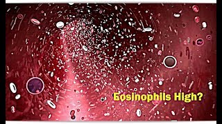 Eosinophils High Low – Causes [upl. by Sevein701]