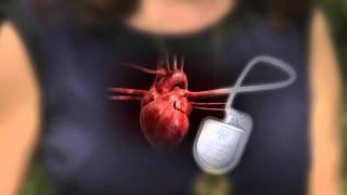 DefibrillatorPacemaker Whats the Difference [upl. by Ron]