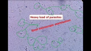 Heavy load of parasites in stool Stool microscopic examination Trichomonas hominis [upl. by Ernaldus]