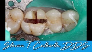 Sectioning and Extraction of Maxilary First Molar  with Steven T Cutbirth DDS [upl. by Suciram]