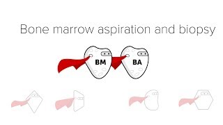 Bone Marrow Biopsy amp Aspiration BMBx [upl. by Akimal]