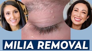 How Do You Remove Milia A Dermatologist Shares Milia Treatment amp Prevention Tips  DERM CHAT [upl. by Aeret]