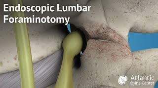 Endoscopic Lumbar Foraminotomy [upl. by Houlberg]