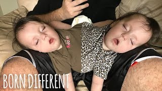 Conjoined Twins Are A Medical Miracle  BORN DIFFERENT [upl. by Oiramal]