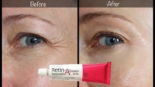 5Year RetinA Update  Before amp After for Wrinkles amp AntiAging [upl. by Victorine734]