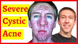 Cystic Acne Skin Clearing Transformation  10 Month Timelapse [upl. by Alfi]