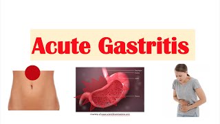 Acute Gastritis Stomach Inflammation  Causes Signs amp Symptoms Diagnosis Treatment [upl. by Aihsatal165]