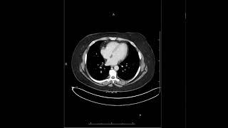 Peritoneum and Mesentery  Carsinomatosis  MRI Online [upl. by Ramuk440]