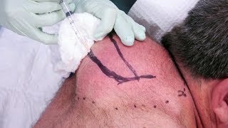 Lénorme boule de Paul  Docteur Pimple Popper [upl. by Batchelor]