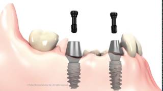 3 unit Bridge on implant abutments [upl. by Bambie341]