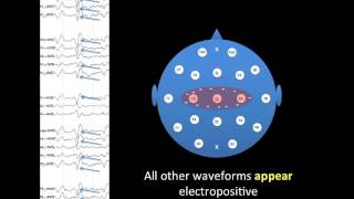 EEG Montages [upl. by Eelesor]