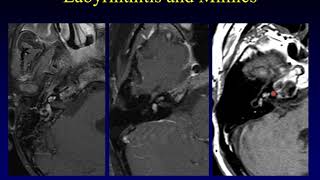 Temporal Bone Pathology 6 Hearing Loss Part 1 [upl. by Dib]