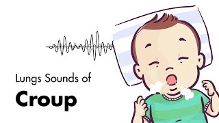 What croup sounds like sound only [upl. by Otsuj]