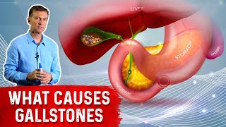 What Really Causes Gallstones  Dr Berg [upl. by Atiraj]