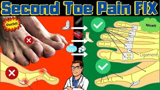 Second Toe Pain TREATMENT Capsulitis Taping amp Freiberg Disease FIX [upl. by Enovad]