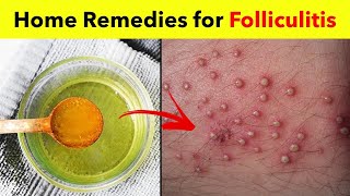 3 Powerful Home Remedies for Folliculitis  Best Folliculitis Treatment at Home [upl. by Renba]