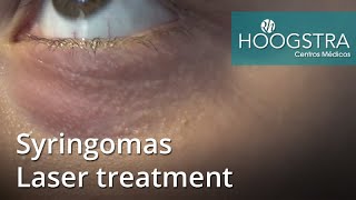 Syringomas  Laser treatment 21024 [upl. by Holub316]