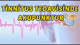 KULAK ÇINLAMASI TİNNİTUS TEDAVİSİNDE AKUPUNKTUR [upl. by Darlleen]