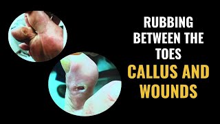 Rubbing Between The Toes  Calluses and Wounds [upl. by Barbra]