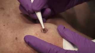 Watch amp Learn Electrosurgery [upl. by Truitt458]