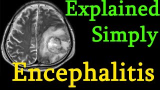 Encephalitis  brain inflammation  Symptoms causes prognosis Treatment explained simply [upl. by Mundy268]