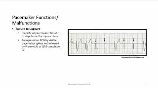 Pacemaker Overview [upl. by Sugihara936]