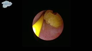 Localization of the ureter stone [upl. by Iow]