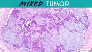 Chondroid Syringoma Mixed Tumor  Like Pleomorphic Adenoma of Skin 5Minute Pathology Pearls [upl. by Florette]