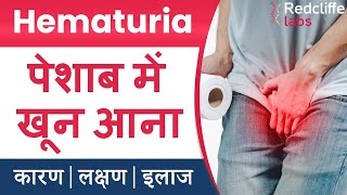 ⛔Hematuria पेशाब में खून आना  Symptoms And Causes in Hindi  ✅ Hematuria Blood in Urine का इलाज [upl. by Mufi]