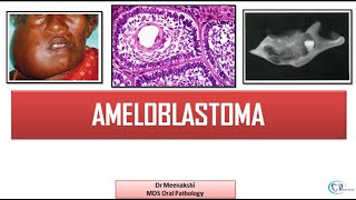 Ameloblastoma  Benign Odontogenic Tumor [upl. by Wainwright]