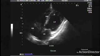 Myocardial infarction echocardiography [upl. by Ticon]