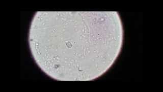 Trichomonas The STD parasite no one seems to know about [upl. by Trevorr]