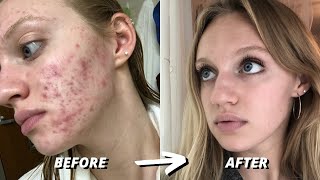 HOW I CLEARED 7 YEARS OF SEVERE ACNE  ACCUTANE JOURNEY [upl. by Anrehs816]