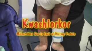 Kwashiorkor [upl. by Ahsinauq]