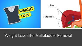 Weight Loss after Gallbladder Removal [upl. by Linette]