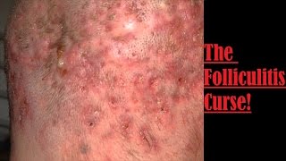 The Folliculitis Curse [upl. by Ko]