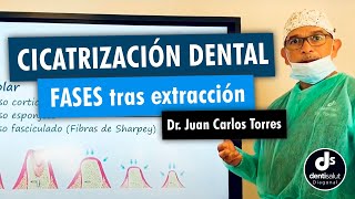 🦷😬 Fases cicatrizacion extraccion dental 😬🦷  Dr Juan Carlos Torres [upl. by Oniliuqnart]