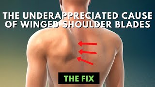 The Underrappreciated Cause of Winged Shoulder Blades  The Fix [upl. by Fulmer51]