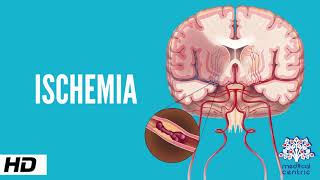 Ischemia Causes Signs and Symptoms Diagnosis and Treatment [upl. by Seditsira]