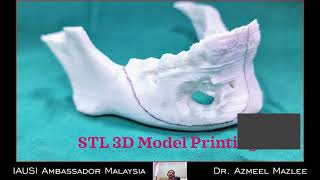 Piezotomeresection of right mandible due to unicystic ameloblastoma [upl. by Hauger]