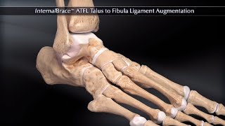 InternalBrace™ ATFL Talus to Fibula Ligament Augmentation [upl. by Fredrick531]