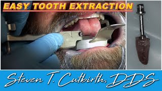 Easy Tooth Extraction  Dental Minute with Steven T Cutbirth DDS [upl. by Malamud25]