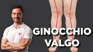 Ginocchio valgo esercizi correttivi [upl. by Squier]