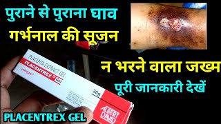 Placentrex Gel Uses Or Side Effects in Hindi [upl. by Ycam]