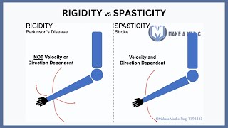 Rigidity vs Spasticity Explained [upl. by Krista]